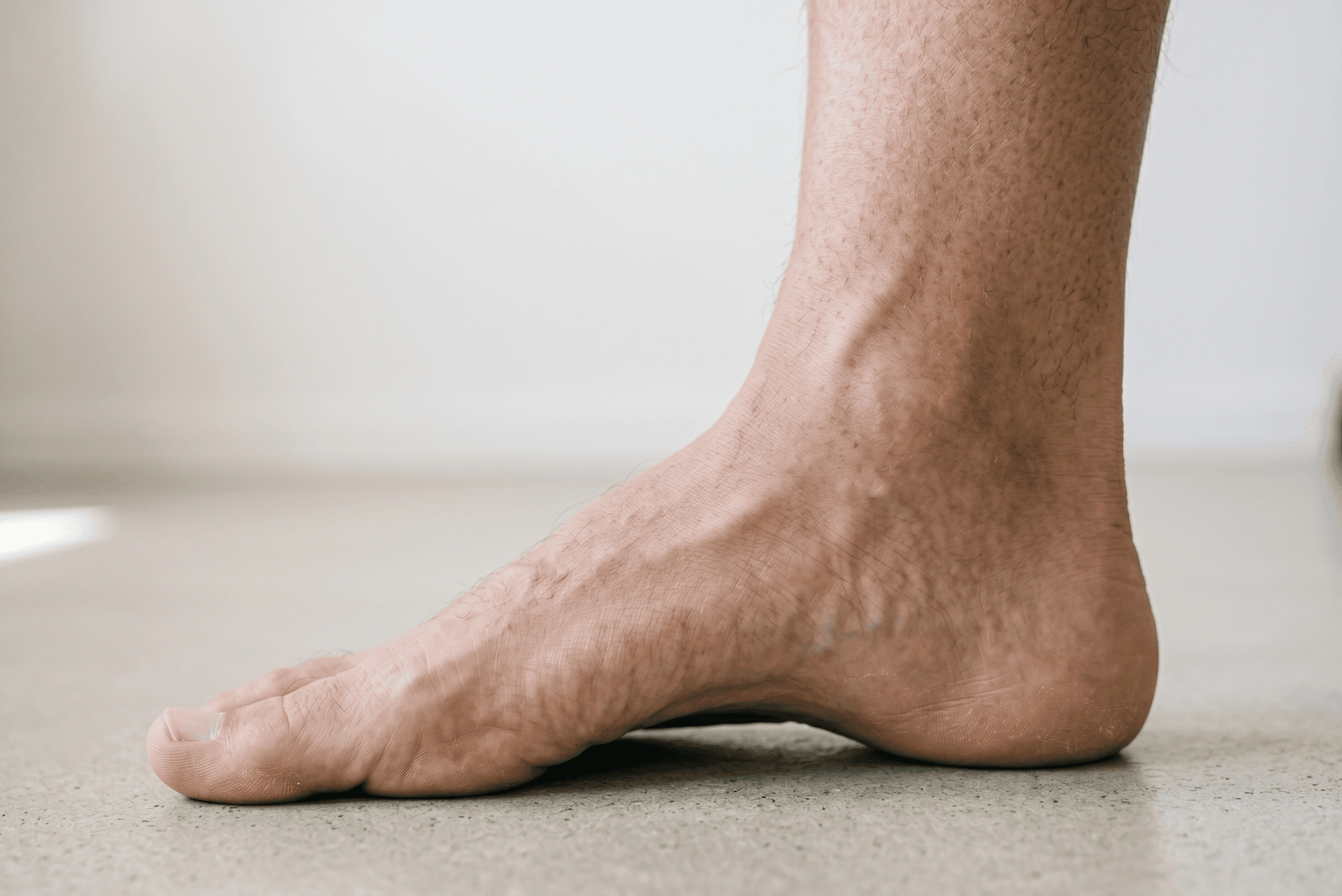 High arched foot — excessive plantar arch